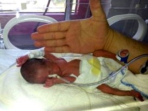 İkiz parmak bebekler, hayata tutundu